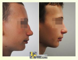 Operácia nosa (Rhinoplastika) - ORL KLINIKA, s.r.o.
