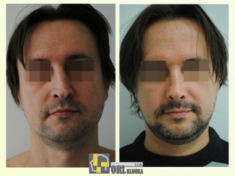 Rhinoplastika - 839558