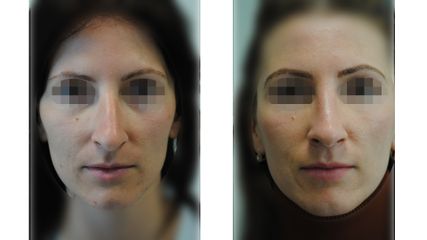 Rhinoplastika - ORL KLINIKA, s.r.o.