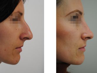 Rhinoplastika pred a po - 871499