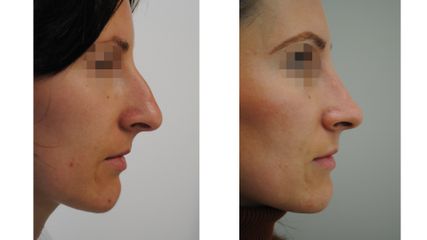 Rhinoplastika - ORL KLINIKA, s.r.o.