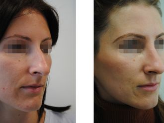 Rhinoplastika pred a po - 871500