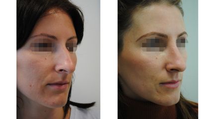 Rhinoplastika - ORL KLINIKA, s.r.o.