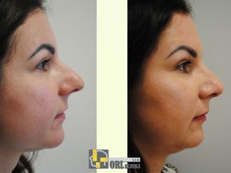 Rhinoplastika pred a po - 876753