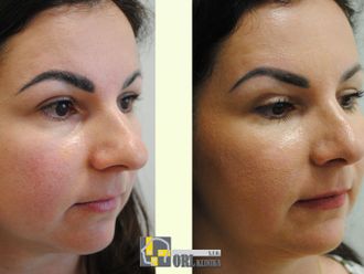 Rhinoplastika pred a po - 876754