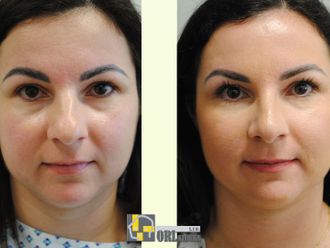 Rhinoplastika pred a po - 876755