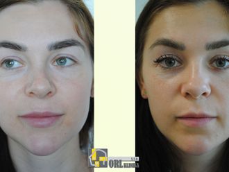 Rhinoplastika pred a po - 876756