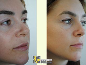 Rhinoplastika pred a po - 876757