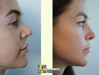 Rhinoplastika pred a po - 876758