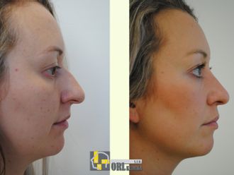 Rhinoplastika pred a po - 877549