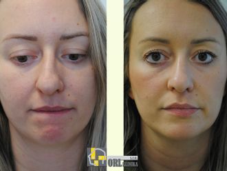 Rhinoplastika pred a po - 877550
