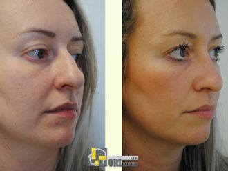 Rhinoplastika pred a po - 877551