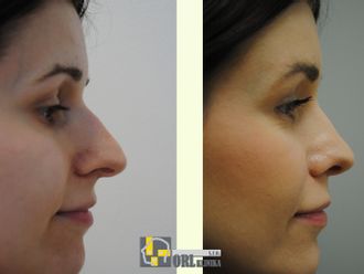 Rhinoplastika pred a po - 878262