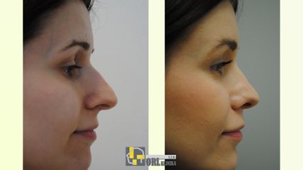 Rinoplastika výsledok