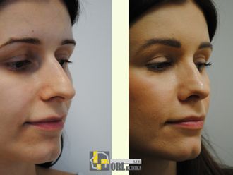 Rhinoplastika pred a po - 878263