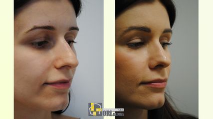 Rinoplastika výsledok