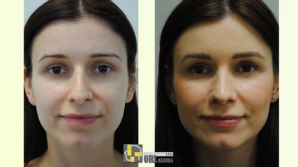 Rinoplastika výsledok
