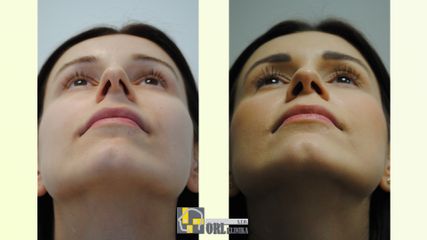 Rinoplastika výsledok