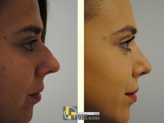 Rhinoplastika pred a po - 878417