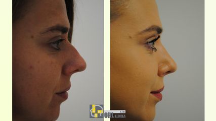 Výsledok po rinoplastike