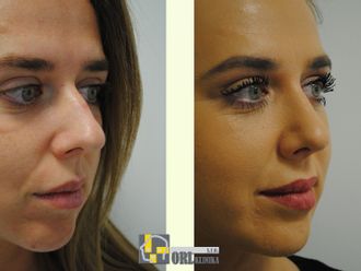 Rhinoplastika pred a po - 878418