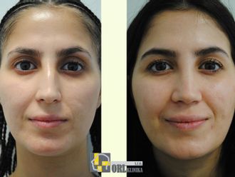 Rhinoplastika pred a po - 878596