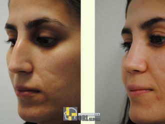 Rhinoplastika pred a po - 878597
