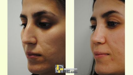 Rhinoplastika