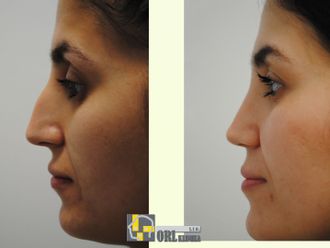 Rhinoplastika pred a po - 878598