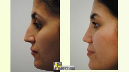 Rhinoplastika