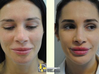 Rhinoplastika pred a po - 878680