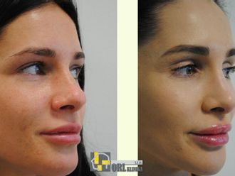 Rhinoplastika pred a po - 878681