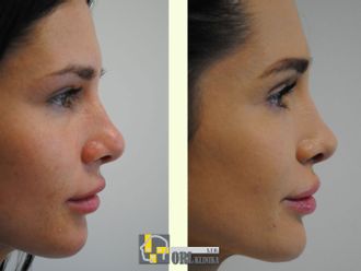 Rhinoplastika pred a po - 878682