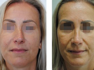 Rhinoplastika pred a po - 881030