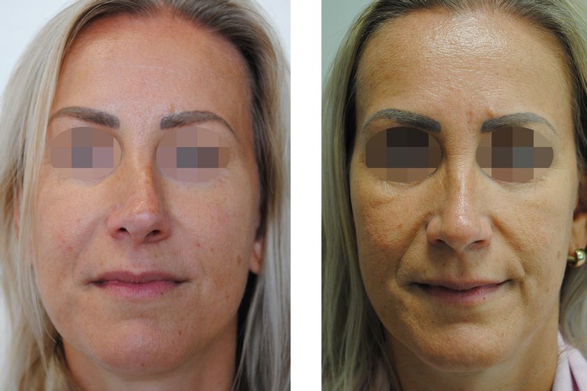 Rhinoplastika pred a po - 881030