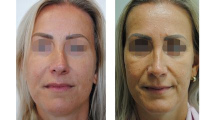 Rinoplastika