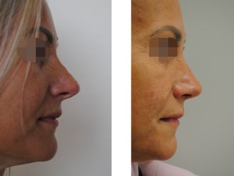 Rhinoplastika pred a po - 881031