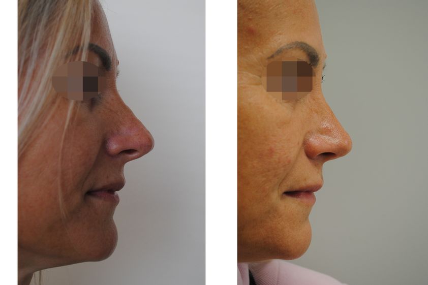 Rhinoplastika pred a po - 881031