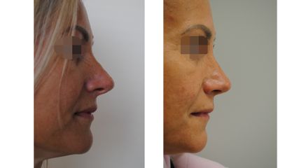 Rinoplastika