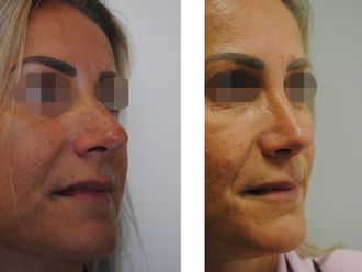 Rhinoplastika pred a po - 881032