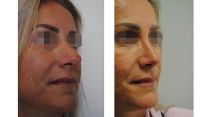 Rinoplastika
