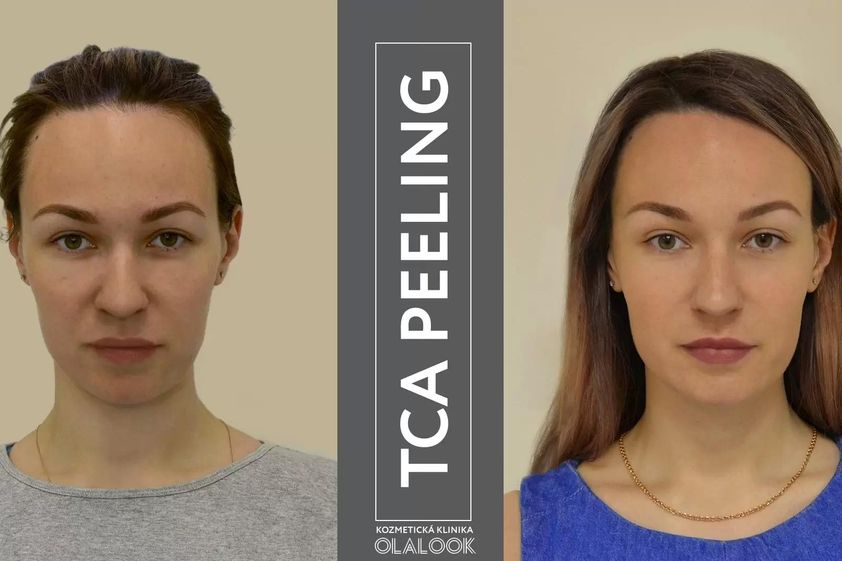 Chemický peeling pred a po - 807028
