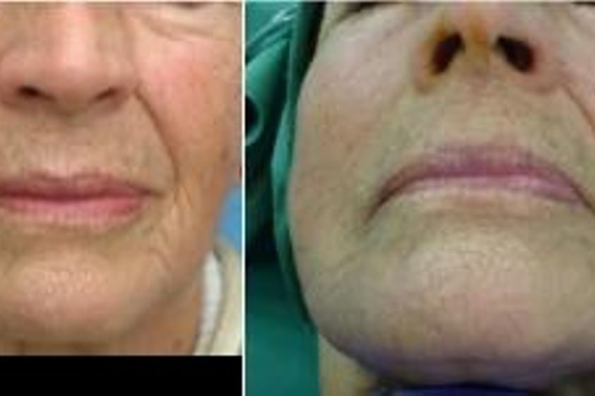 Plazma terapia pred a po - 803329