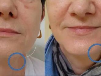 Facelift pred a po - 803335