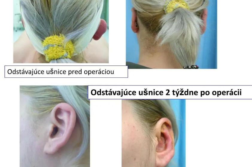 Otoplastika pred a po - 803336