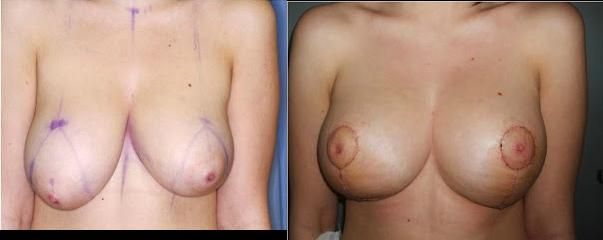 reduk3