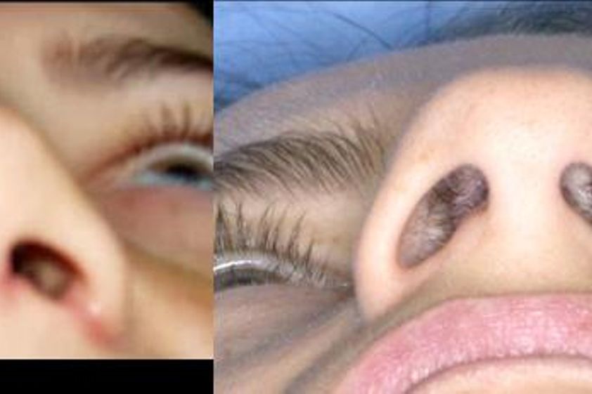 Rhinoplastika pred a po - 803355