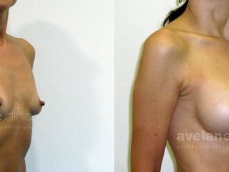 Zväčšenie pŕs pred a po - 802320