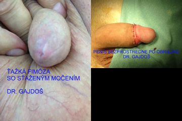 Penis pred a bezprostredne po obriezke