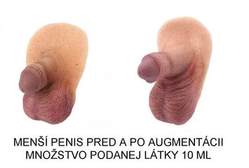 Zväčšenie penisu. Penis enlargement surgery - phalloplasty, penoplasty